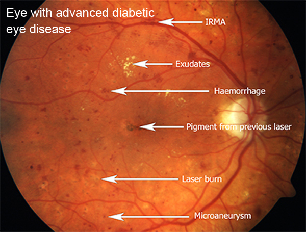 fundus eye with advanced diabetic