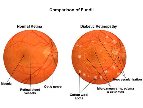 fundus - comparison of Fundii